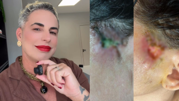 Ministério Público pede indenização de R$ 500 mil para pacientes deformadas por dentista influencer no ES; veja relato das vítimas