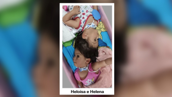 Médicos concluem em 6h penúltima etapa de separação de gêmeas unidas pela cabeça no interior de SP